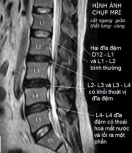 Chụp MRI cột sống thắt lưng