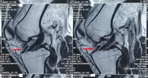 Chụp MRI khớp gối