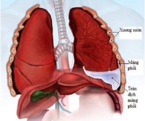 Tràn dịch màng phổi