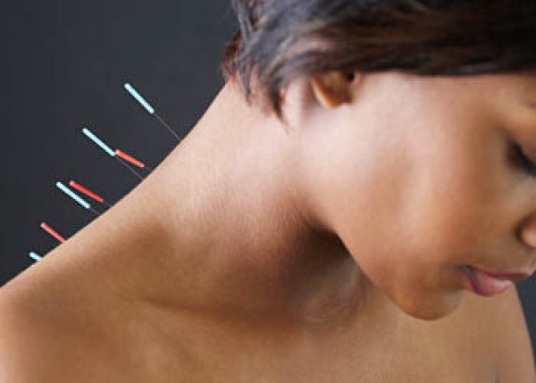 CHÂM CỨU ĐIỀU TRỊ VẸO CỔ CẤP TÍNH - Y thuật cổ truyền