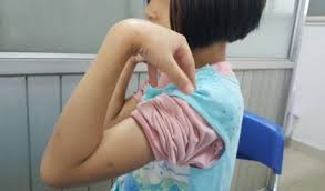 Phục hồi chức năng gãy trên lồi cầu xương cánh tay